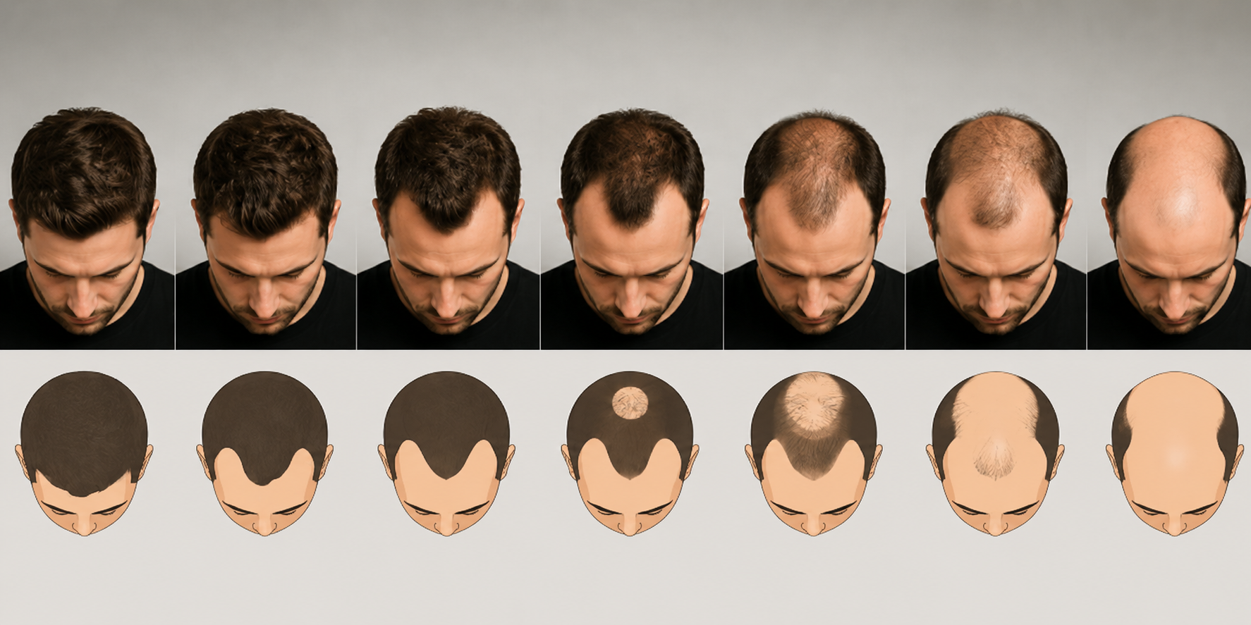 De Norwood Scale: in welk stadium zit jij?